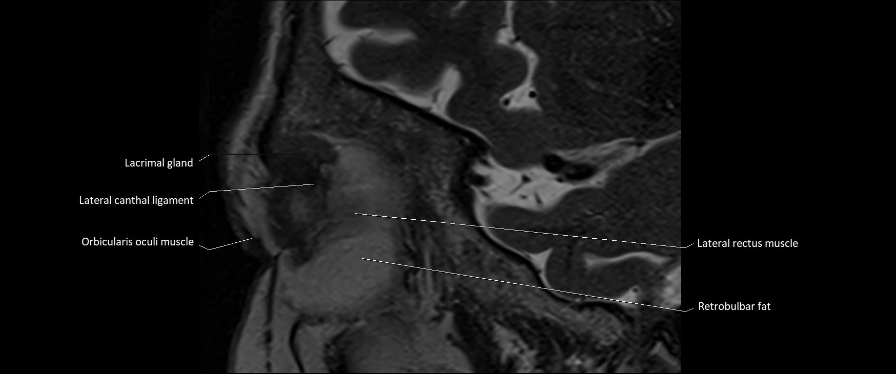 MRI Orbit sagittal cross sectional anatomy 3T image 16.webp